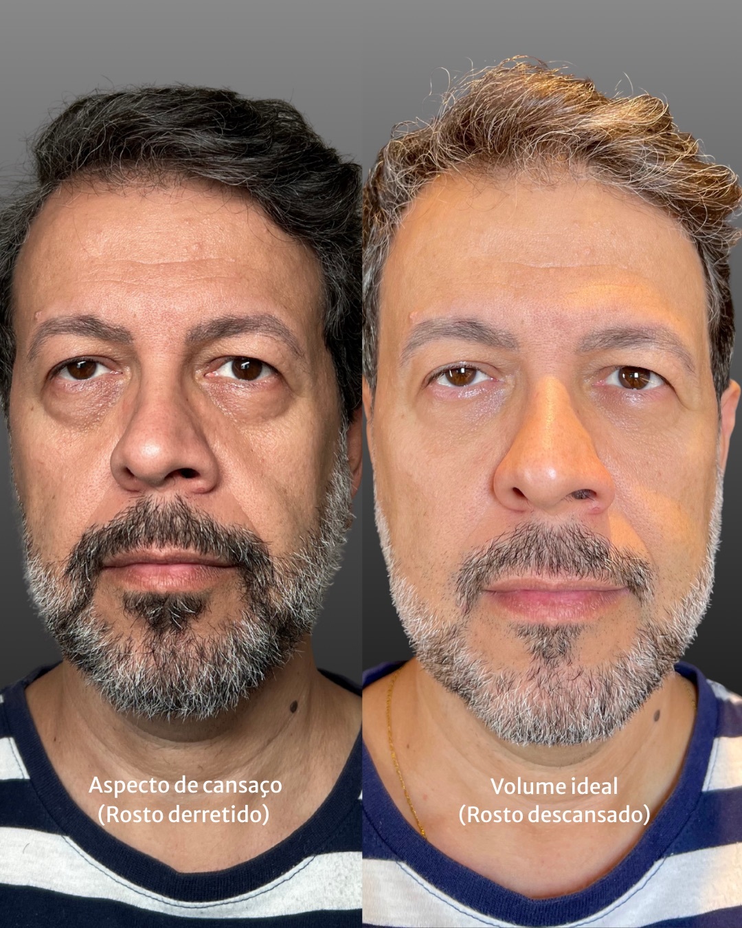 Olheiras profundas - 1